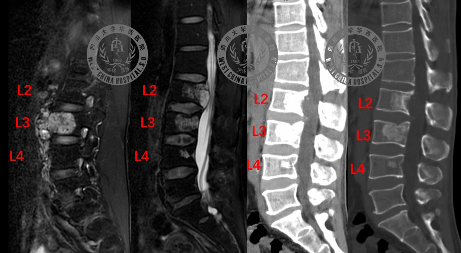 世界级难度！长满肿瘤的腰椎椎骨被整块切除，医院用3D打印技术为他重建 
